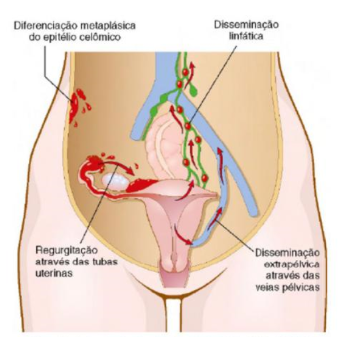 Endometriose: se preocupe com cólicas muito fortes